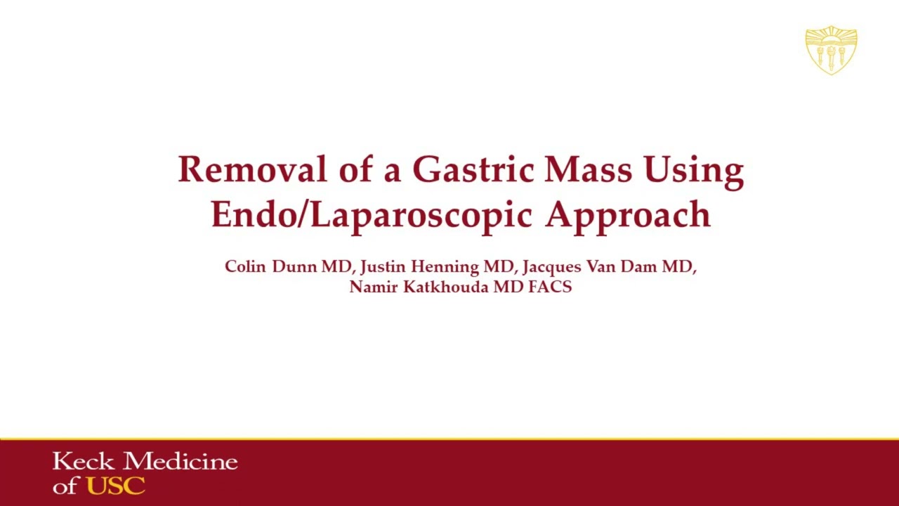 Removal of a Gastric Mass Using a Combined Endoscopic/Laparoscopic Technique
