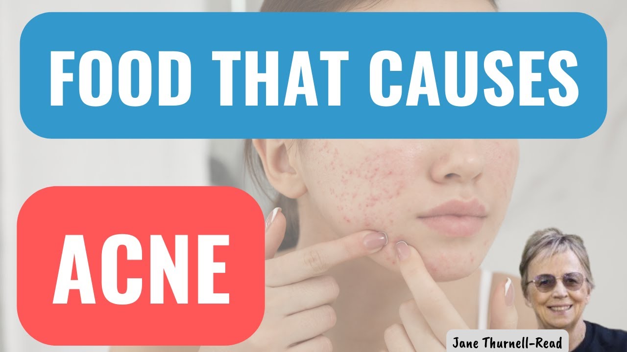 Which Foods Cause Acne? ResearchBased Information YouTube