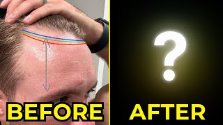 My Decision to Get Hair Transplant Surgery. The 'Before' Video by Ben Carpenter 2,826 views 1 month ago 4 minutes, 8 seconds