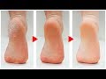 How to Get Rid of Calluses on Feet Naturally