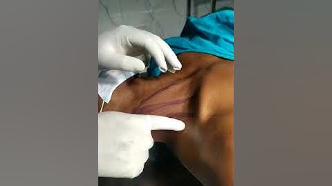 Supraclavicular brachial plexus block paraesthesia technique (Part 1 of 2)