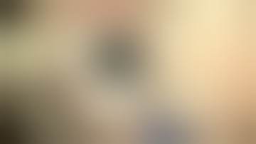 Subluxed traumatic cataract surgery with 2 sutured CTS segments by Steven G. Safran MD