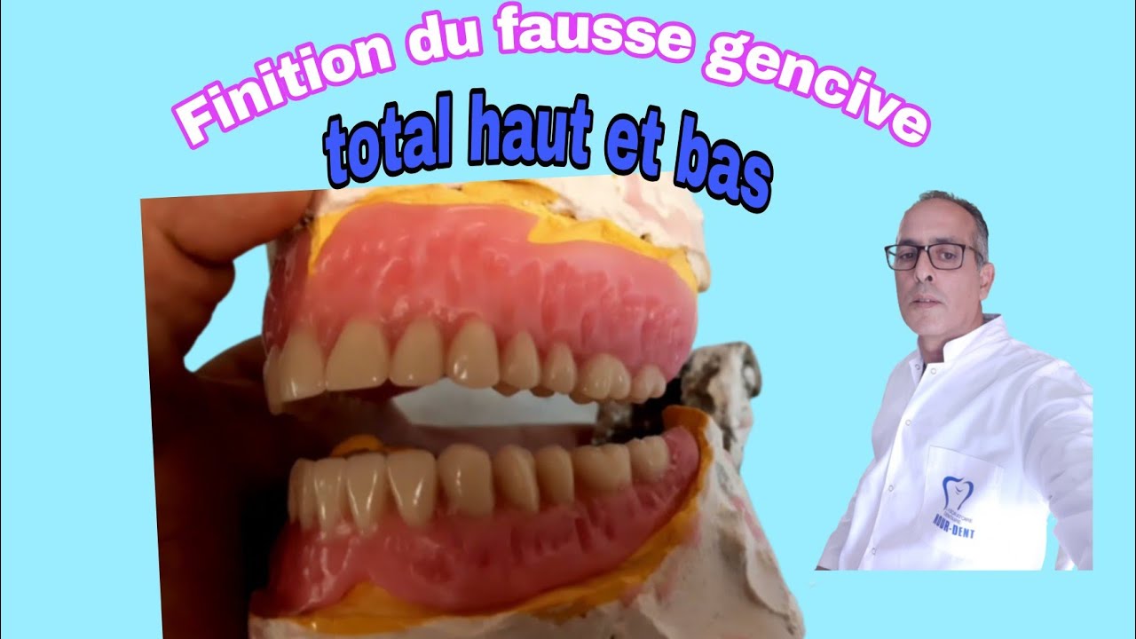2ème partie. Finition du cire fausse gencive. Total haut et bas