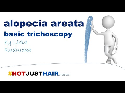 Video: Alopecia Areata: Årsager, Symptomer Og Diagnose
