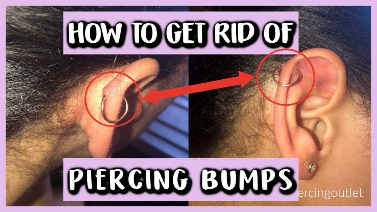 Irritation Bumps v Keloids | What Are Keloids | Piercing Advice | Athame