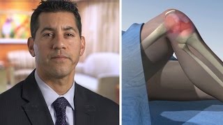 Bone Marrow Stem Cell Treatment (BMAC) for Knee Osteoarthritis - Mayo Clinic