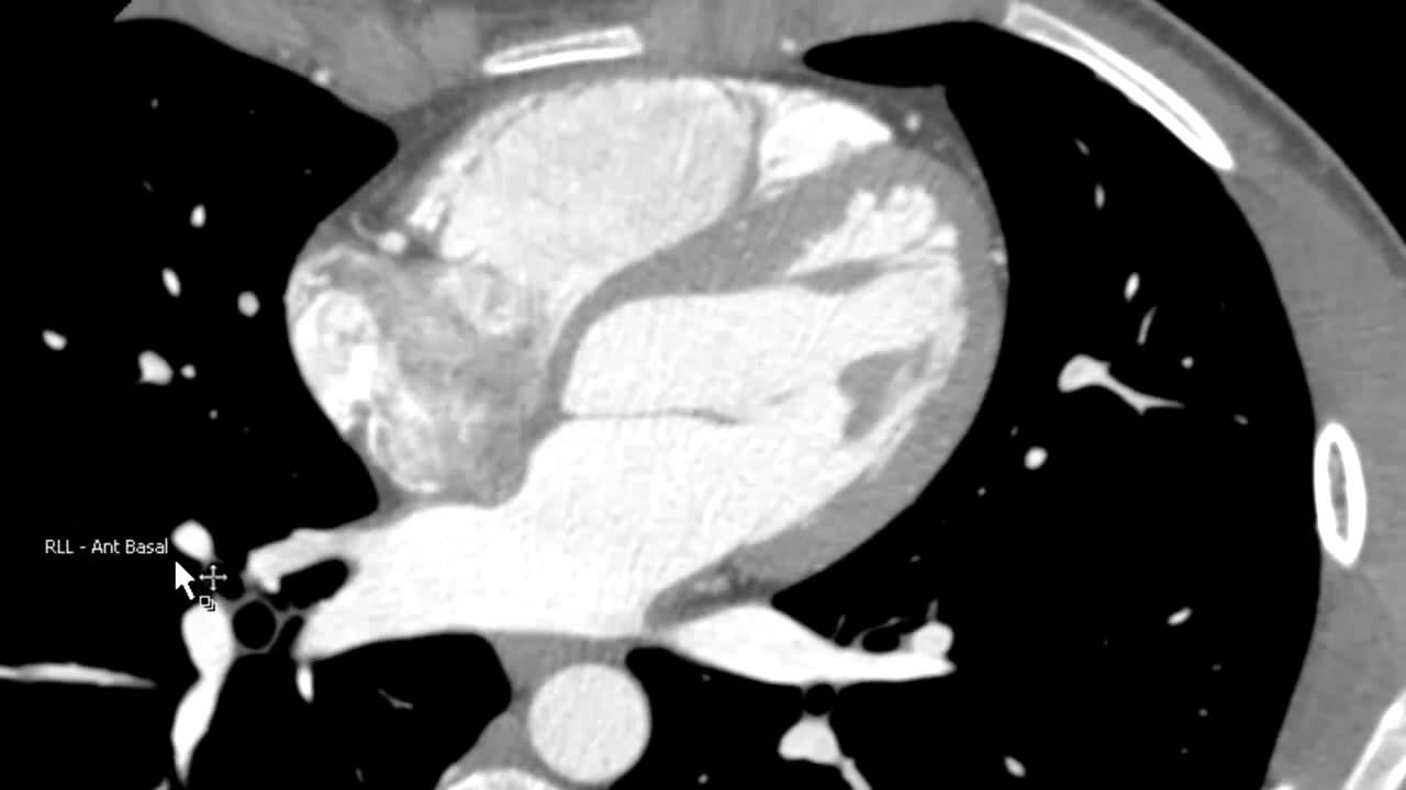 Right Pulmonary Artery on Axial CTA - YouTube