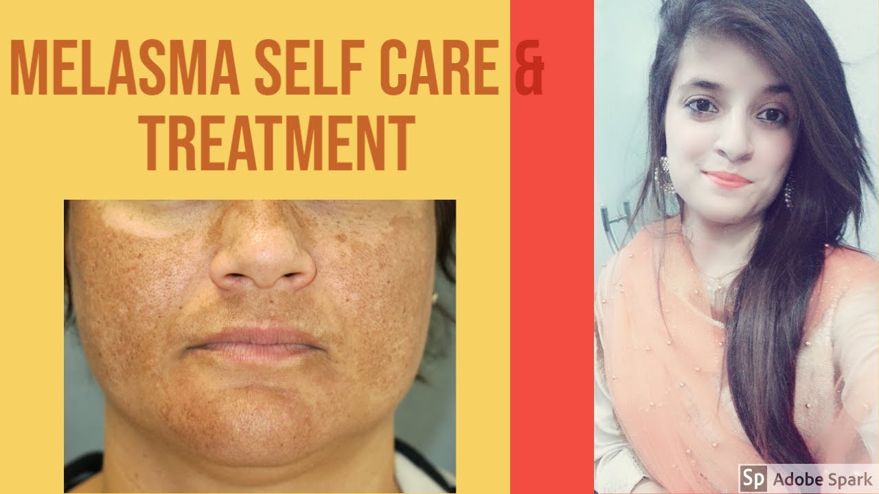 MELASMA TREATMENT AND CARE |MELASMA| HYPERPIGMENTATION| HOW TO TREAT