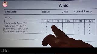 Widal Test Report | Widal Test In Hindi | Widal Test Report Reading In Hindi | widal report positive
