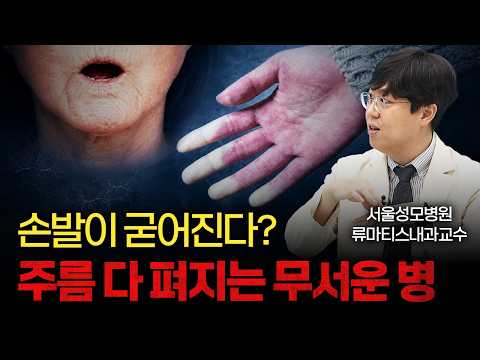 Thought you were just wrinkle-free, but it's a rare disease turning your body to stone? [Professo...