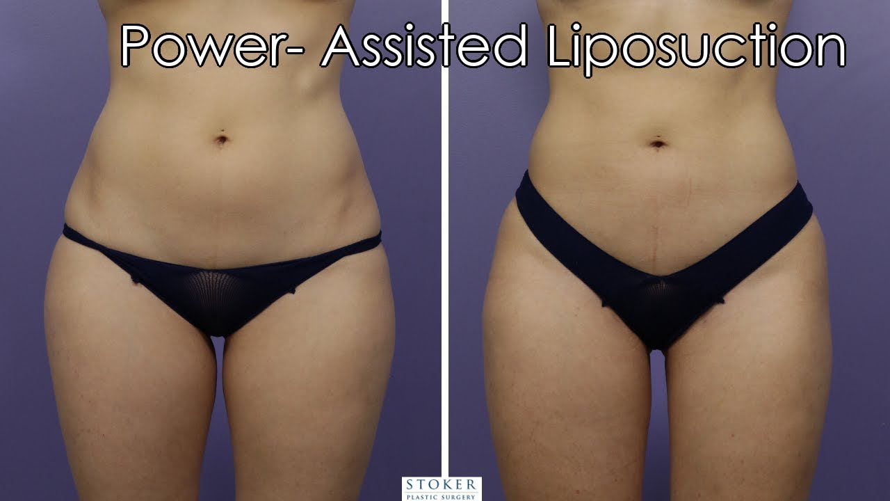 Liposuction Los Angeles: Plastic Surgeon Dr. David Stoker 360 Degree Body  Contouring 1 Year Results 