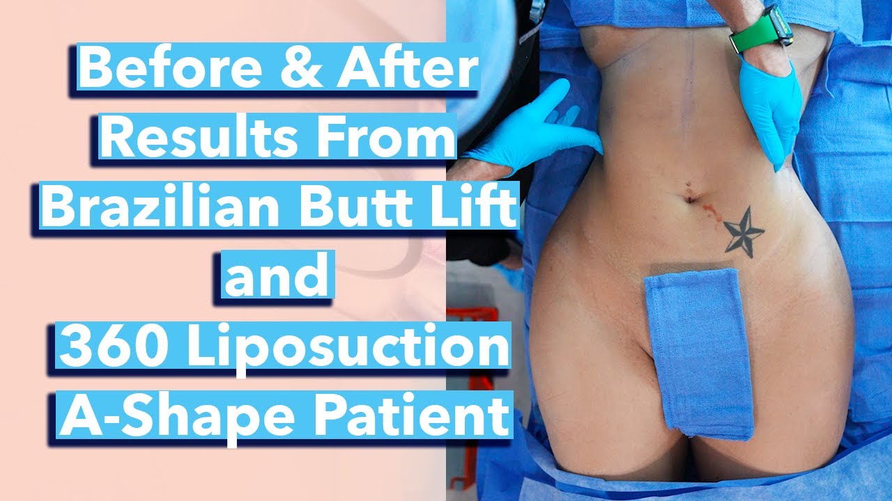 Before and After Results From Brazilian Butt Lift (BBL) and 360 ...