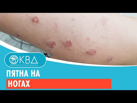 Пятна на ногах. Клинический случай №108