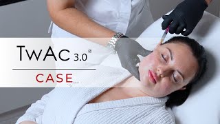 Twac 3.0 For Face Deep Hydration And Rejuvenation