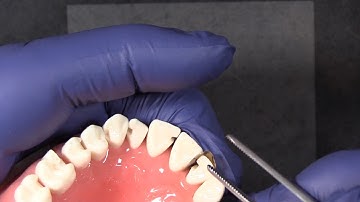 Quick Tip #10 | Placing the Fusion Anterior Bands