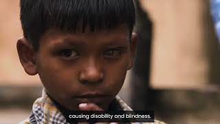 End child leprosy today