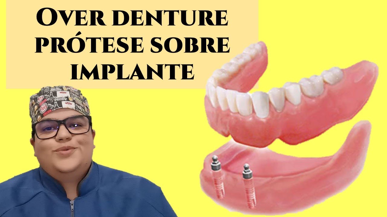 Overdenture uma prótese sobre implante| Dra Bianca Rosa