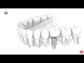 Apel la consilier - Beneficiile implanturilor dentare | Implanturi rapide VS implanturi traditionale