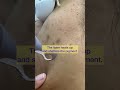 Laser Skin Toning For Dark Spots Nypunya Aesthetic Clinic Bangalore 