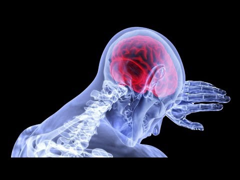 فيديو: أعراض السكتة الدماغية وأسبابها وعلاجها