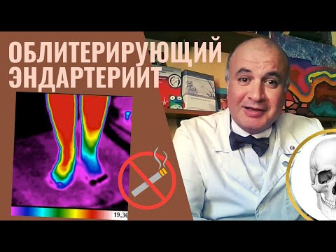 Облитерирующий  ЭНДАРТЕРТЕРИИТ. Синдром "ноги курильщика"