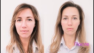 Хиромассаж лица (до и после процедуры)