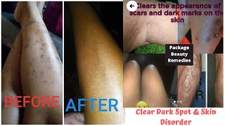 Dark Spot Remover Cream and Allergy (Psoriasis, Eczema, Insect Bite) Treatment for All Skin Types.