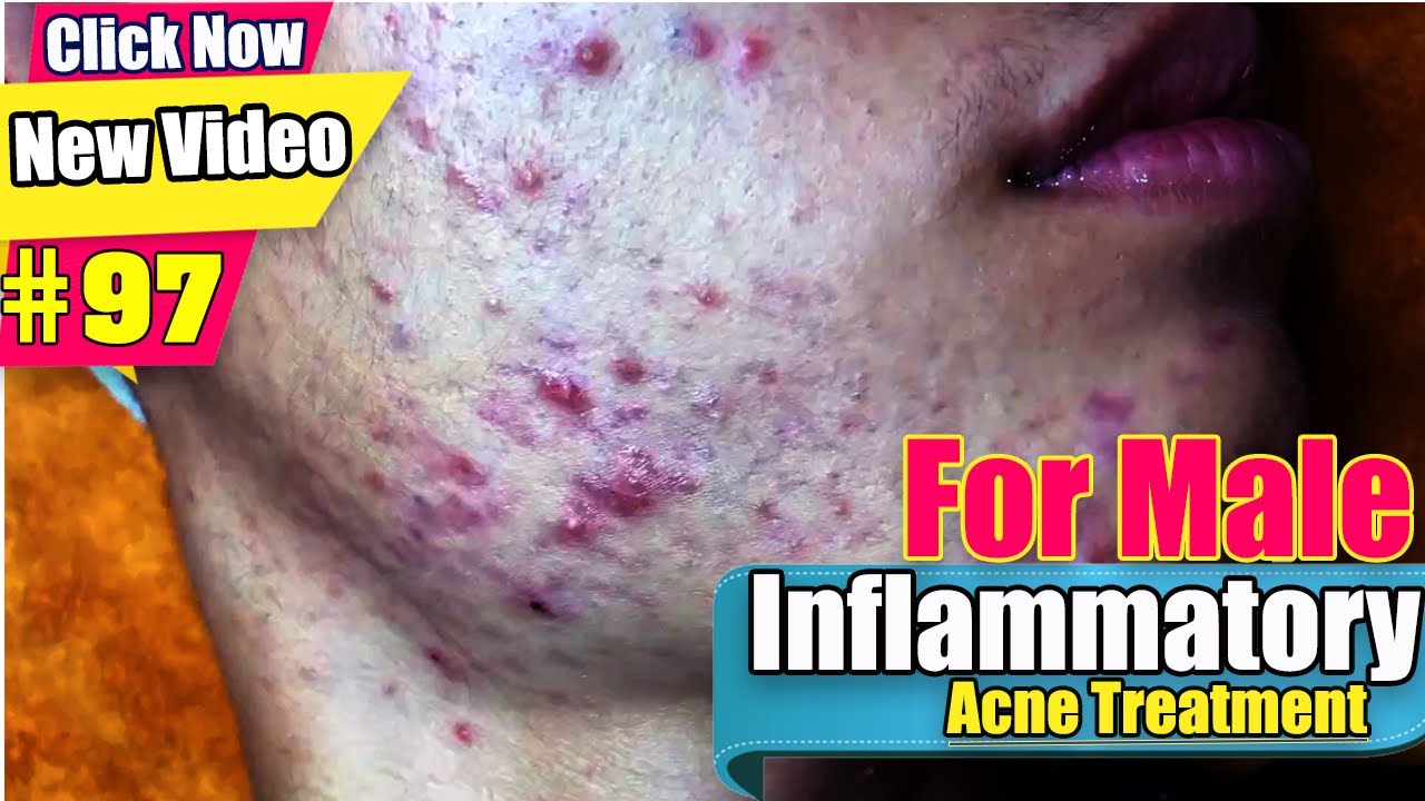 Treating Inflammatory  Acne and Blackheads for male clients - Acne Treatment(#97)