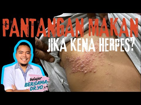 HATI-HATI!! Ini pantangan makanan saat terkena penyakit herpes zoster atau dompo