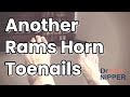 Throwback - Veronica's Thick Toenails and Ram's Horn Nail