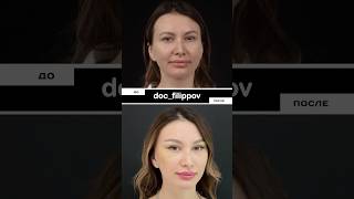 Результат через 2 НЕДЕЛИ. Напомню, был выполнен эндоскопический лобно-височный лифтинг.
