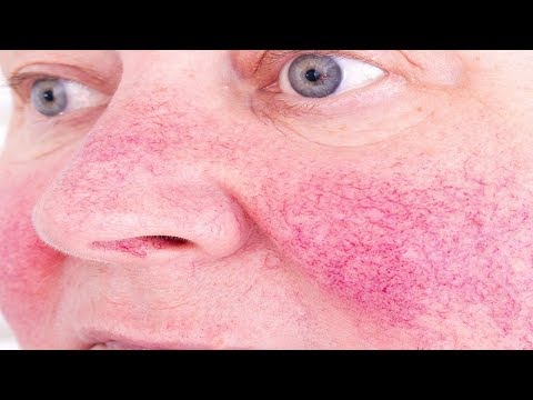 How to Get Rid of Rosacea Naturally.