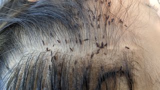 Most of head lice are cleared - Remove a thousand head lice from brown hair