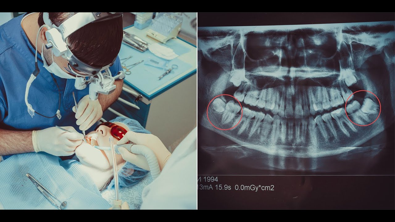 Удаление зуба мудрости. Операция по удалению ретиннированых зубов ...