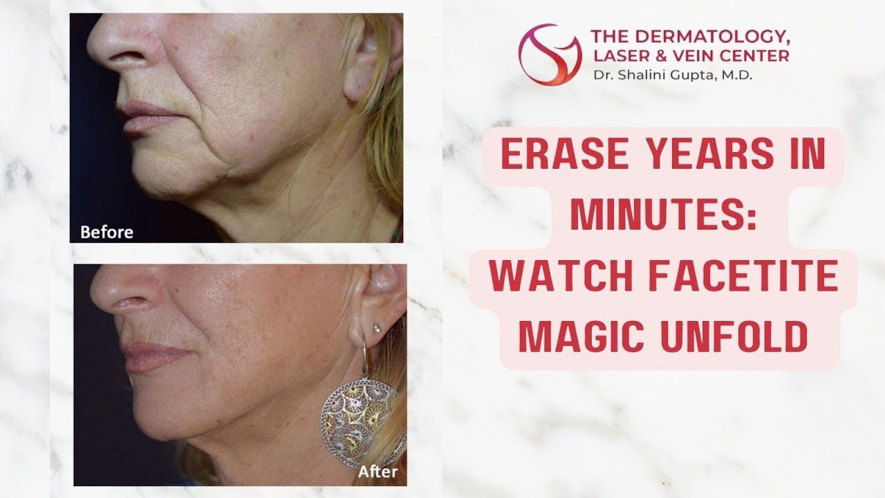 FaceTite/BodyTite/AccuTite Cincinnati