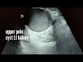 Hemorrhagic cyst left kidney, ultrasound and color Doppler video