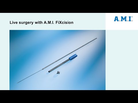 Live surgery with A.M.I. FiXcision - video from A.M.I.