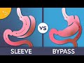 Gastric Sleeve vs Bypass Surgery: What
