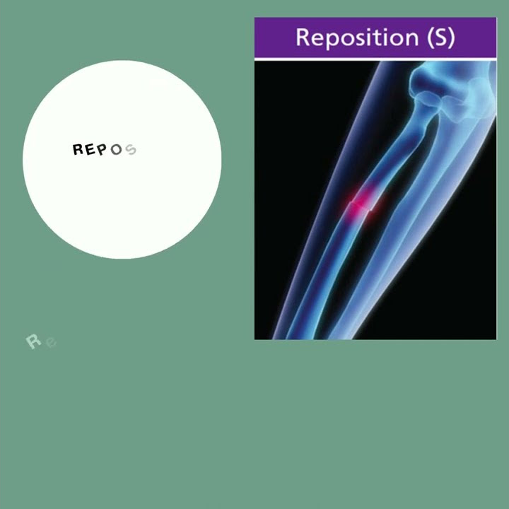 Icd 10 pcs root operation group 4 reposition shorts youtube