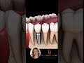 IMPLANTES DENTÁRIOS🦷✨ #dentista #odontologia #implantedentário