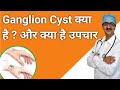 What is a Ganglion Cyst  And It's Treatment in Hindi || गन्ग्लिओन क्या होता है और इसका इलाज क्या है
