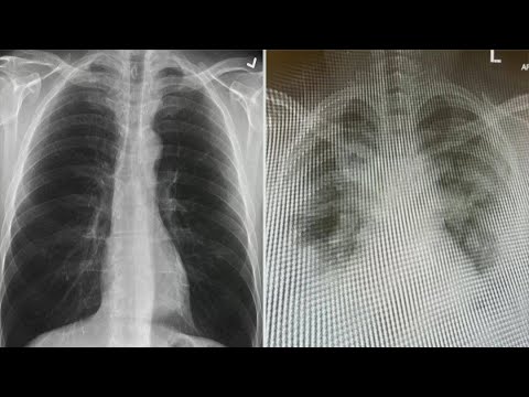 ER doctor shares alarming lung X-rays of COVID-19 patients