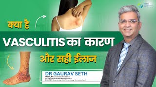 क्या है Vasculitis का कारण और सही ईलाज? |Vasculitis : causes, symptoms & treatment |Dr. Gaurav Seth