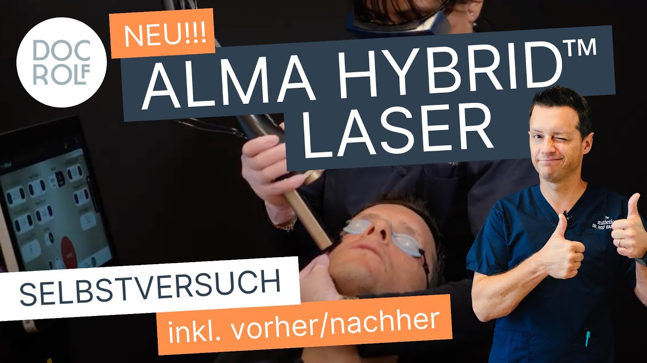 ALMA (CO2) HYBRID™ LASER Selbstversuch und vorher/nachher an Dr. Rolf Bartsch YouTube