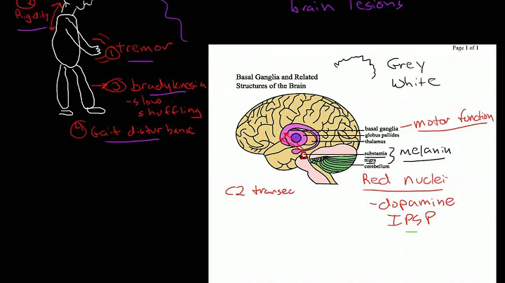 Parkinson's Dementia