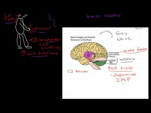 Parkinson&rsquo;s Dementia