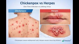 Drugs For Herpes Simplex Virus (HSV) & Varicella Zoster Infection