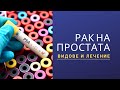 Рак на простата - видове и лечение