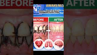 #oralhealth #cancer @KrishnaAvyu@who @Lionfield @facebook862 @CancerResearchUK
