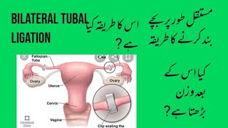 postpartum tubal ligation and it's practical